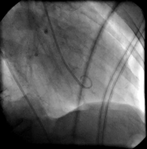 The coronary angiography shows a pathognomonic „apical ballooning“.