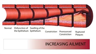 Stages of atherosclerosis.