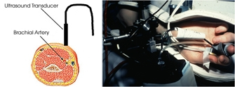 Fig. 3: Measurement of forearm blood flow as well as radial artery diameter during flow-mediated vasodialtion to determine endothelial function in healthy subjects and patients with cardiovascular disease.