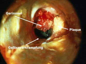 Fig. 5: Thrombosis