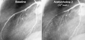 Fig. 4: Quantitative coronary angiography to assess coronary vasomotion and endothelial function: The left anterior descending coronary artery is shown at baseline (top) und after infusion of acetylcholine (Ach) which – unlike in healthy arteries - causes profound paradoxical vasoconstriction of the diseased artery as a reflection of endothelial dysfunction (from: ENCORE-1, T.F. Lüscher et al. Circulation 2003).