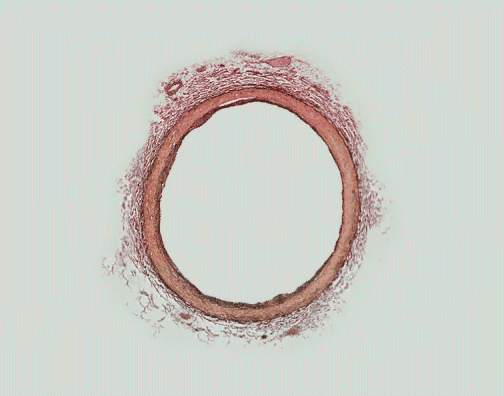 Development of an atherosclerotic plaque in a coronary artery over decades